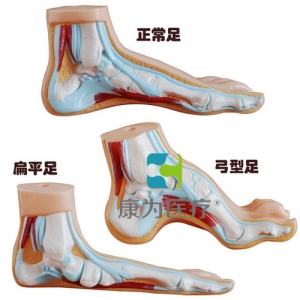 “康為醫(yī)療”正常足、扁平足、弓型足模型