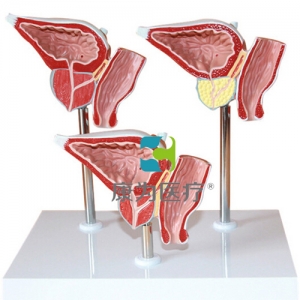 “康為醫(yī)療”前列腺病理模型